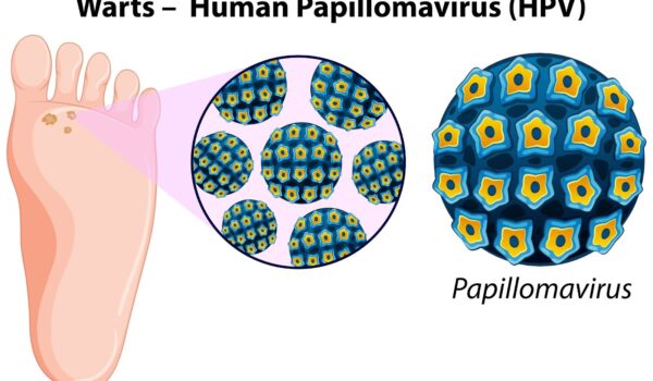 Navigating Plantar Warts: The Impact of the HPV Vaccine